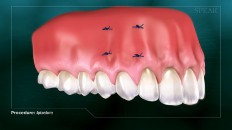 side shot of gums with incisions