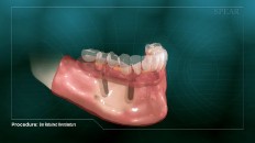 lower teeth with implant sockets