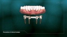 front view of a denture prosthesis