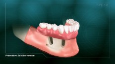 side view of the bottom teeth prosthesis