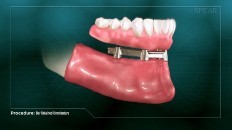 bottom dentures on a prosthesis