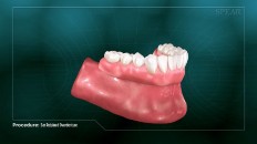 completed bottom dentures