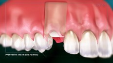 a bone graft placed on a bone