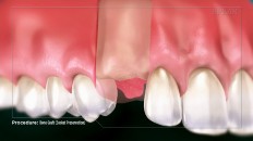 a side view of a jaw with a bone graft