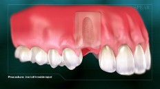gums with an empty spot for an implant
