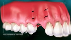 gums covering the new implant area