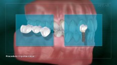 a tooth bridge and implant
