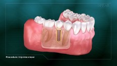 cross section of gums with an implant