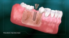 gums with a temporary tooth