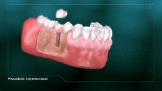 gums with an implant being places
