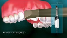 teeth being scanned by a hand scanner