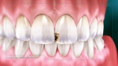 a front tooth with slight damage