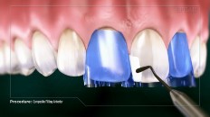 the tooth being filled with composite material