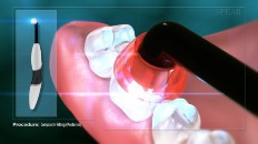 a handheld curing light over the tooth