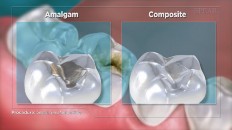 an amalgam and composite next to each other