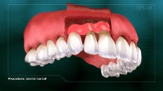 gums from a different area being placed