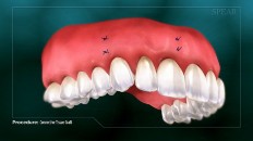 gums that have been sutured