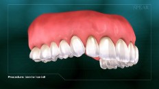 teeth with healthy gums