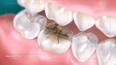 an infected cracked tooth