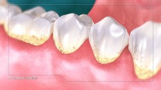 teeth yellowing at the bottom