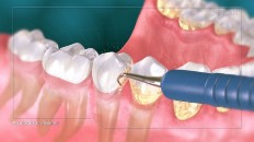 teeth being scraped with a tool