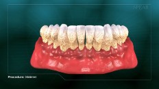 a front view of a bottom row of teeth