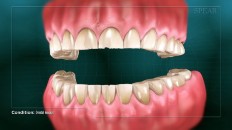 front view of eroded teeth