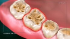 top view of eroded teeth