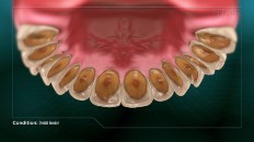 bottom up view of eroded teeth