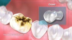 a tooth that needs a crown