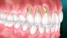 teeth with receding gums