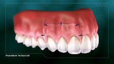 a gum graft with stitches