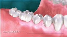 a set of teeth with gum disease