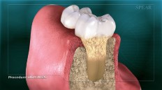 a cross section of teeth with gum disease