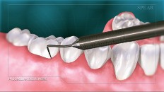 a tooth being scraped by a tooth pick