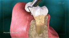 teeth with gum disease