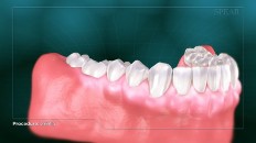 teeth with inflamed gums