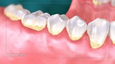 teeth with red gums and yellowing teeth