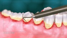 teeth being scraped with a tool