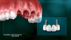 a set of teeth with three missing