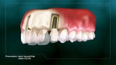 three teeth with implants