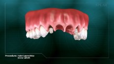 a section of gums with implants