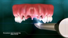 implant sockets being scanned