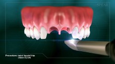 implant sockets being scanned