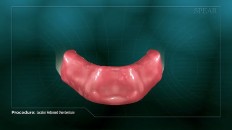 a bottom denture