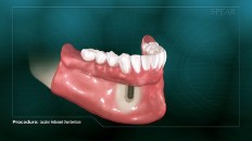 bottom dentures on a prosthesis