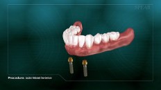 bottom dentures over a pair of screws