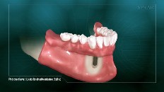 a set of bottom dentures