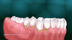 teeth with plaque around the gumline