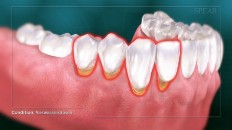 teeth circled in a red line